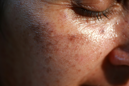 Hyperpigmentation: Everything You Need to Know from the Experts