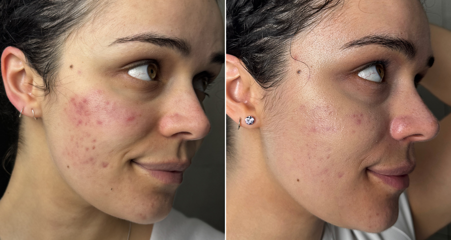 Red Light Therapy Before & After: Pictures and Results