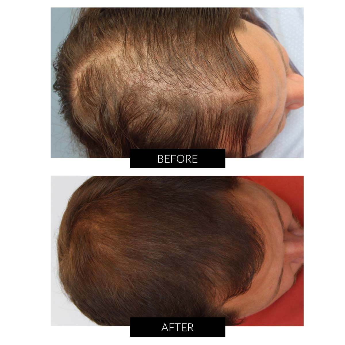 Hair treatment cap deals