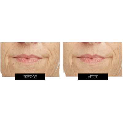 CurrentBody Skin LED Lip Perfector