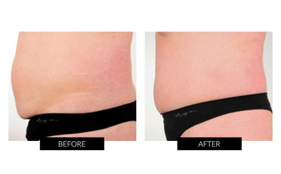 Before and After model images for the TriPollar POSE Skin Tightening Device 